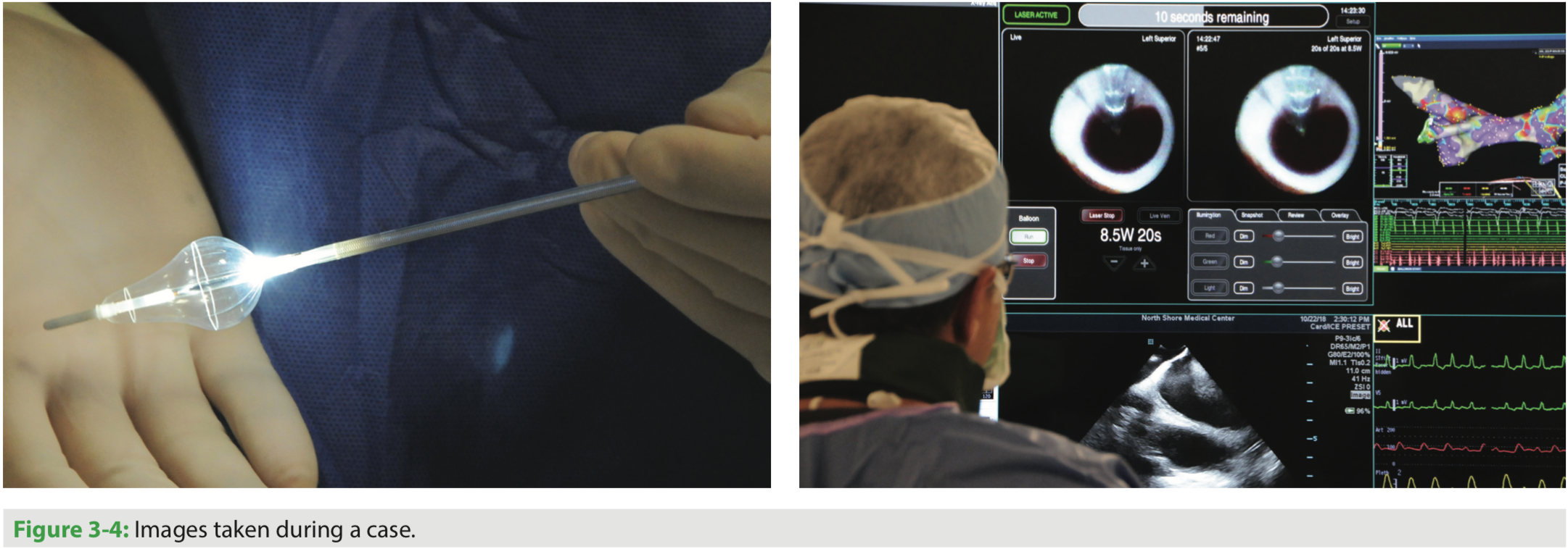 Laser Balloon Pulmonary Vein Isolation Initial Experience at Florida